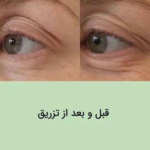 درمان چروک دور چشم