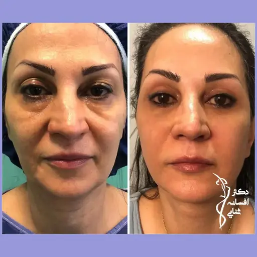 تزریق چربی با روش نوراریژن
