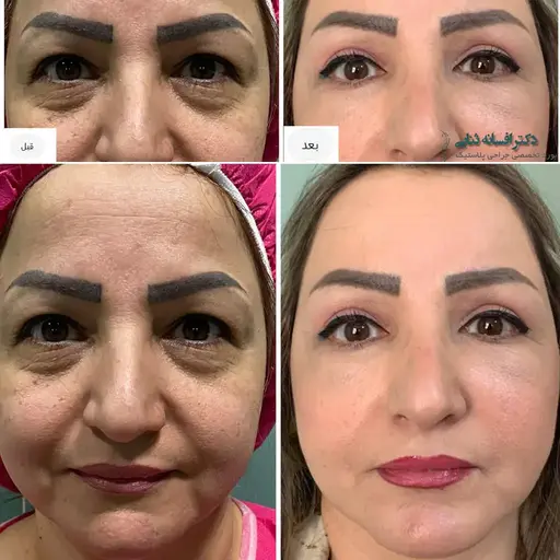 تزریق چربی زیر چشم
