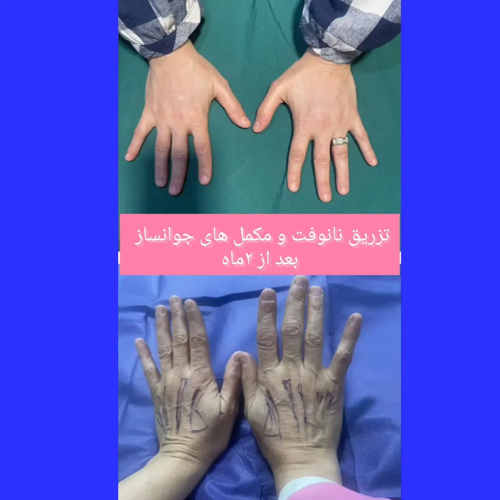 تزریق چربی به پشت دست با روش نانوفت | قبل و بعد از تزریق چربی به دست